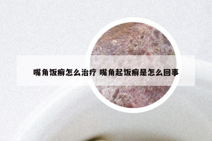 嘴角饭癣怎么治疗 嘴角起饭癣是怎么回事