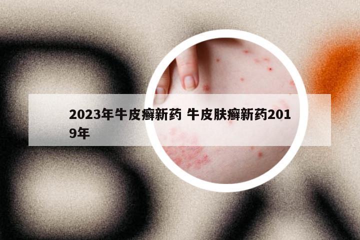 2023年牛皮癣新药 牛皮肤癣新药2019年