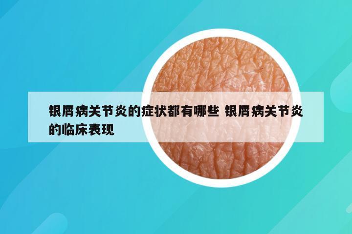 银屑病关节炎的症状都有哪些 银屑病关节炎的临床表现