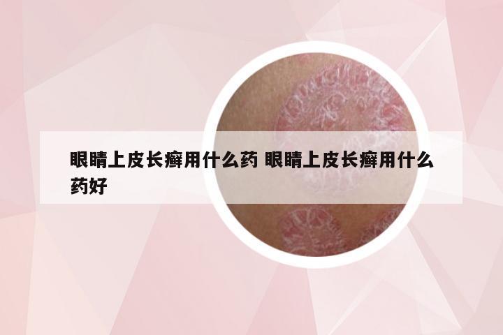 眼睛上皮长癣用什么药 眼睛上皮长癣用什么药好