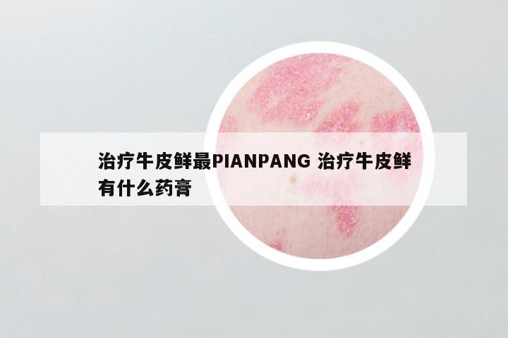 治疗牛皮鲜最PIANPANG 治疗牛皮鲜有什么药膏