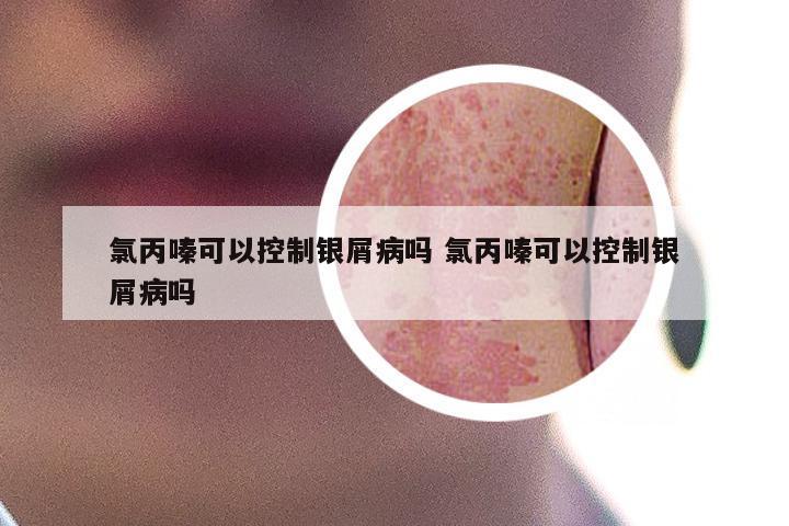 氯丙嗪可以控制银屑病吗 氯丙嗪可以控制银屑病吗