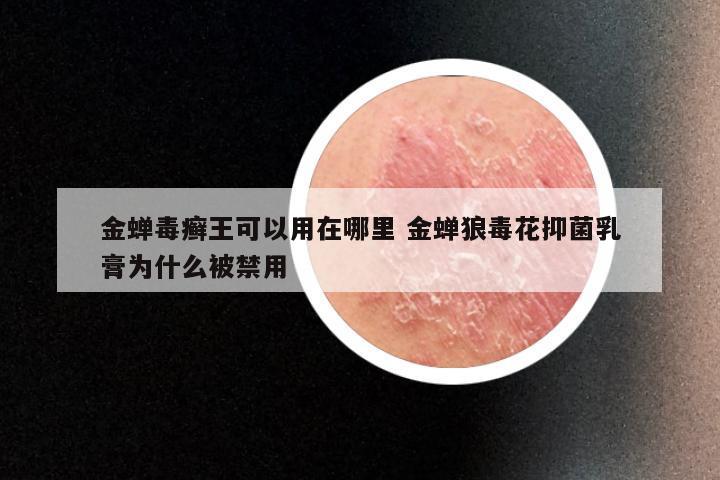 金蝉毒癣王可以用在哪里 金蝉狼毒花抑菌乳膏为什么被禁用