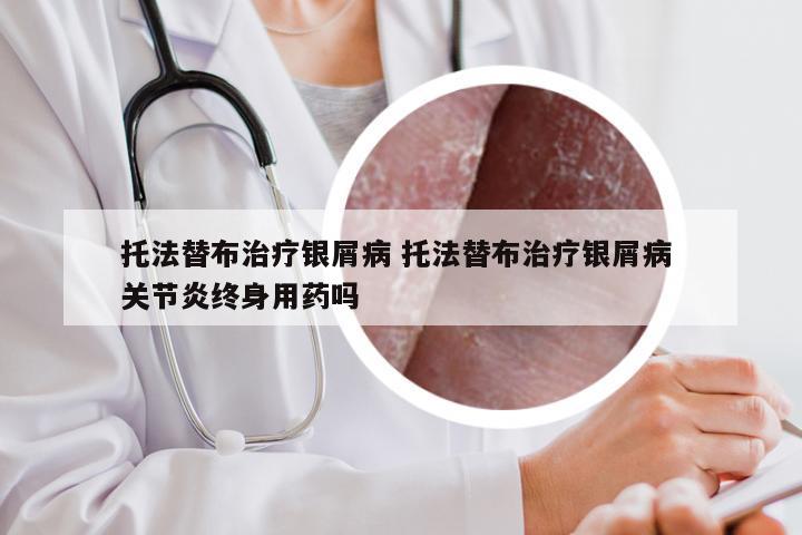 托法替布治疗银屑病 托法替布治疗银屑病 关节炎终身用药吗