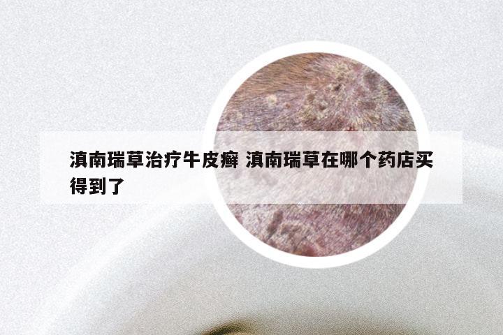 滇南瑞草治疗牛皮癣 滇南瑞草在哪个药店买得到了