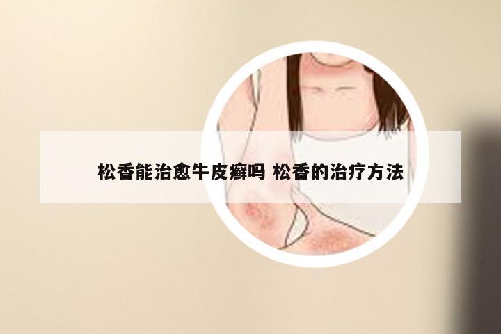 松香能治愈牛皮癣吗 松香的治疗方法