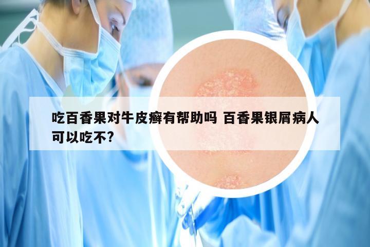 吃百香果对牛皮癣有帮助吗 百香果银屑病人可以吃不?