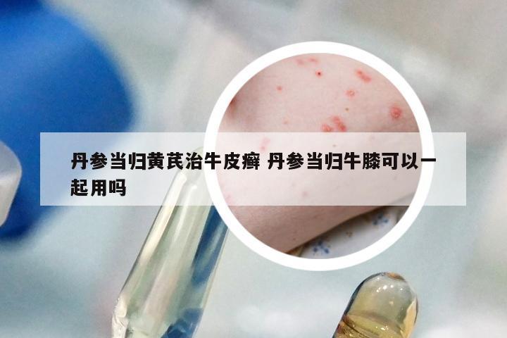 丹参当归黄芪治牛皮癣 丹参当归牛膝可以一起用吗