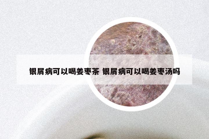 银屑病可以喝姜枣茶 银屑病可以喝姜枣汤吗