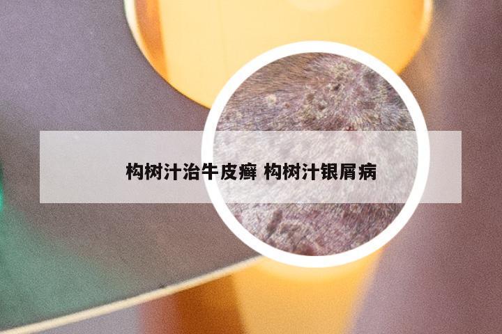 构树汁治牛皮癣 构树汁银屑病