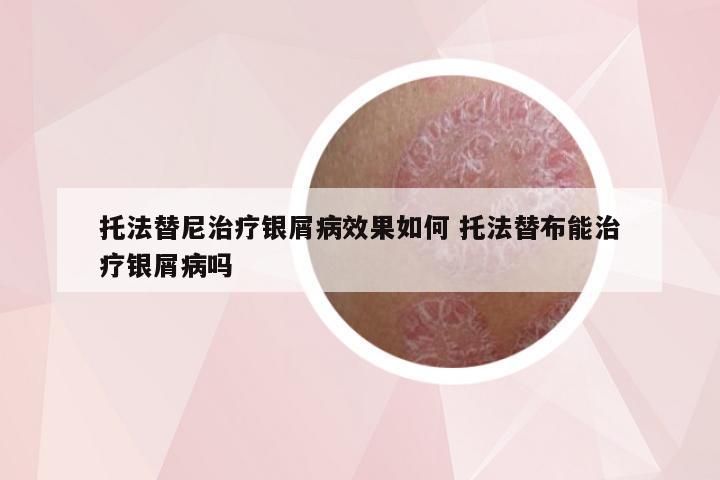 托法替尼治疗银屑病效果如何 托法替布能治疗银屑病吗