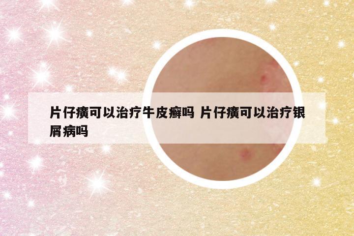 片仔癀可以治疗牛皮癣吗 片仔癀可以治疗银屑病吗