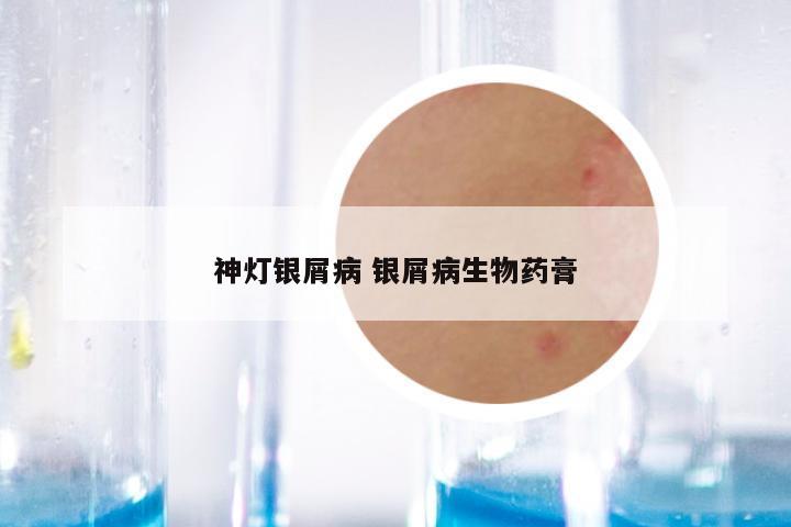 神灯银屑病 银屑病生物药膏