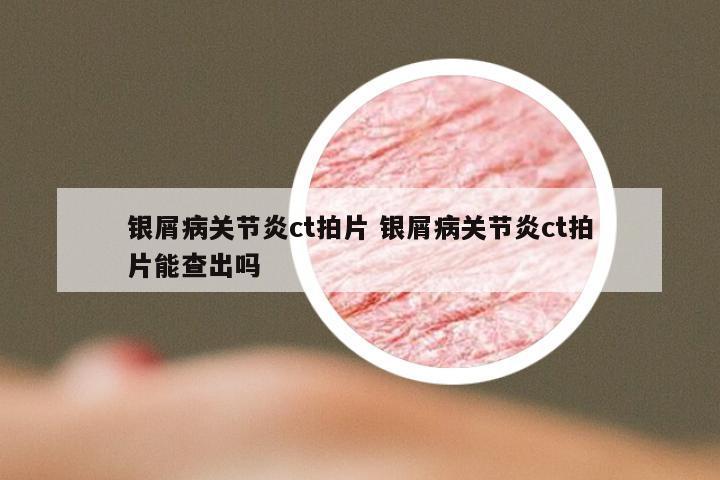 银屑病关节炎ct拍片 银屑病关节炎ct拍片能查出吗