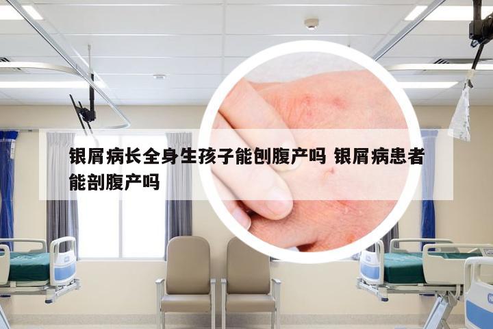 银屑病长全身生孩子能刨腹产吗 银屑病患者能剖腹产吗