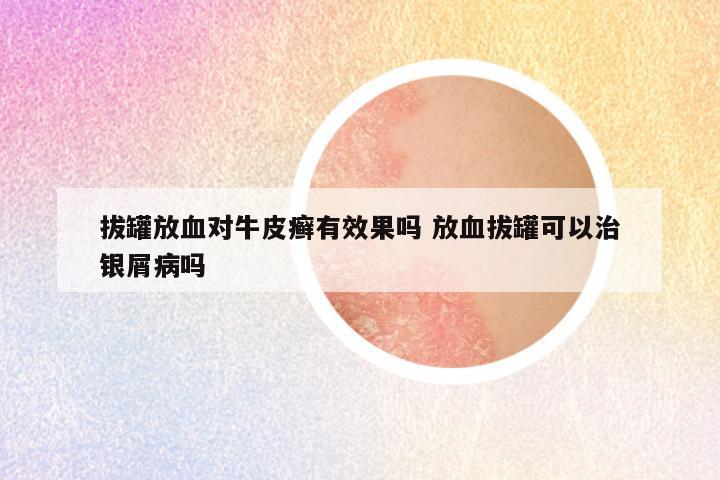 拔罐放血对牛皮癣有效果吗 放血拔罐可以治银屑病吗