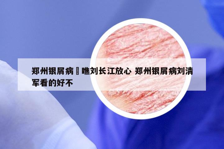 郑州银屑病來瞧刘长江放心 郑州银屑病刘清军看的好不