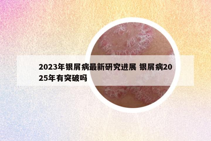 2023年银屑病最新研究进展 银屑病2025年有突破吗