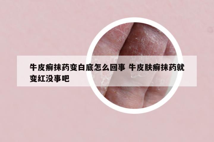 牛皮癣抹药变白底怎么回事 牛皮肤癣抹药就变红没事吧