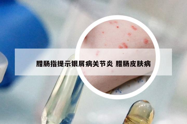 腊肠指提示银屑病关节炎 腊肠皮肤病