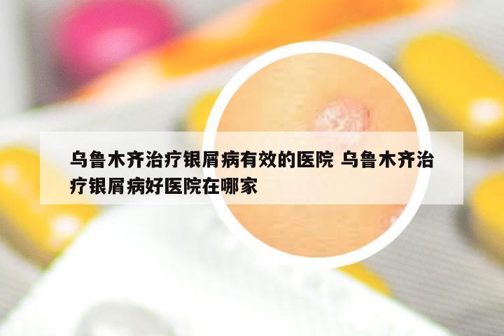 乌鲁木齐治疗银屑病有效的医院 乌鲁木齐治疗银屑病好医院在哪家