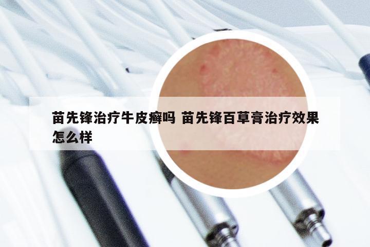 苗先锋治疗牛皮癣吗 苗先锋百草膏治疗效果怎么样