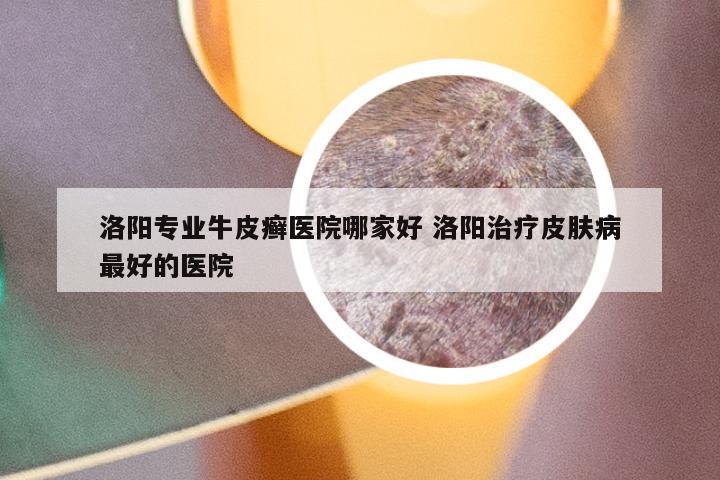 洛阳专业牛皮癣医院哪家好 洛阳治疗皮肤病最好的医院