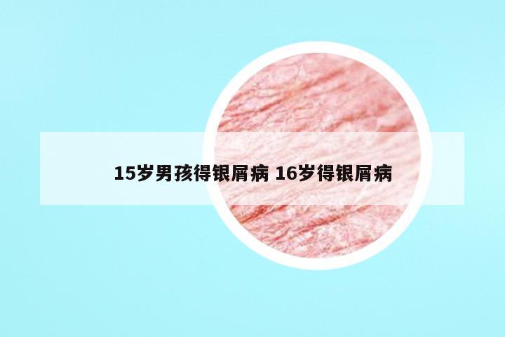 15岁男孩得银屑病 16岁得银屑病