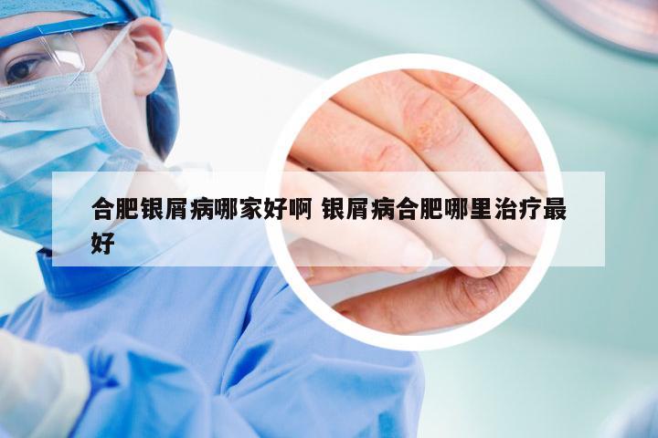 合肥银屑病哪家好啊 银屑病合肥哪里治疗最好