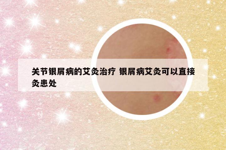 关节银屑病的艾灸治疗 银屑病艾灸可以直接灸患处