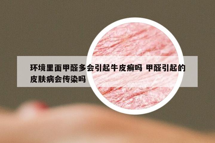 环境里面甲醛多会引起牛皮癣吗 甲醛引起的皮肤病会传染吗