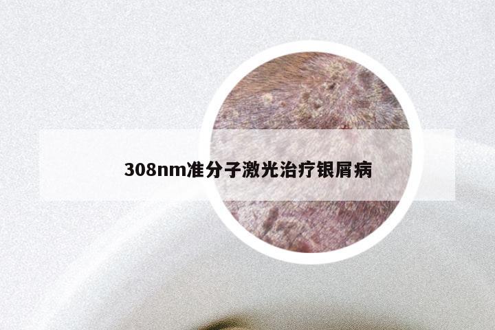 308nm准分子激光治疗银屑病